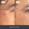 imageRescue Balm PostBlemish Recovery Cream from Hero Cosmetics  Intensive Nourishing and Calming for Dry RedLooking Skin  Dermatologist Tested and VeganFriendly 15 ml 05 fl oz